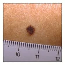 Close-up photo of a skin lesion with a ruler held next to it